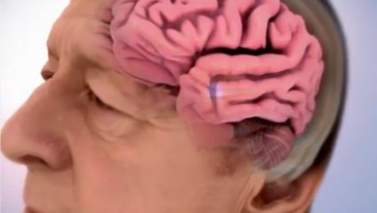 Alzheimer: ¿Puede desarrollarse a temprana edad?
