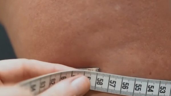 Celulitis ¿Cómo combatirla y evitar que sea una enfermedad?

