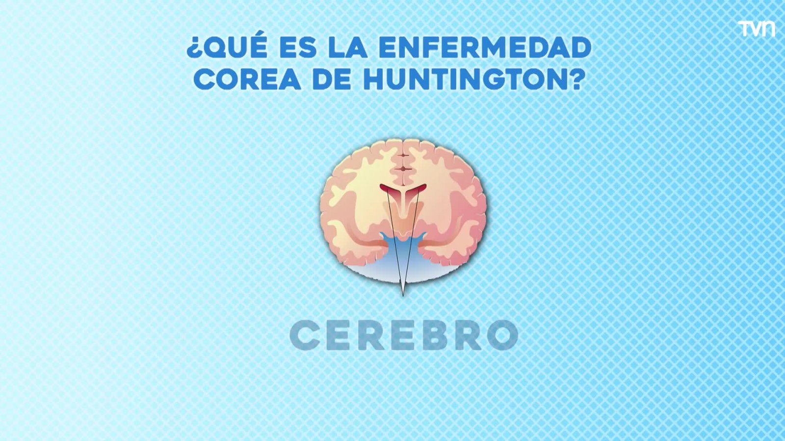 ¿Qué es la enfermedad corea de Huntington?
