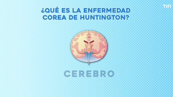 ¿Qué es la enfermedad corea de Huntington?

