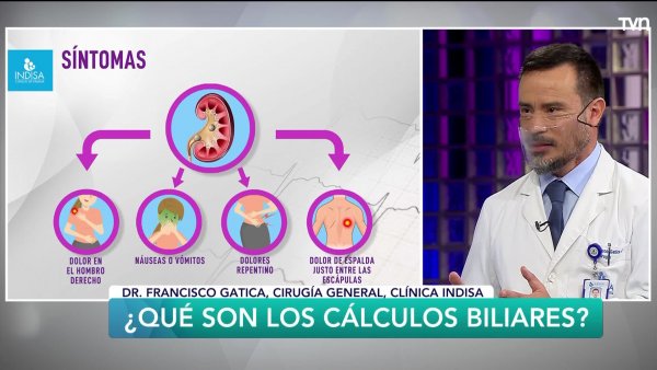 ¿Qué son los cálculos biliares?
