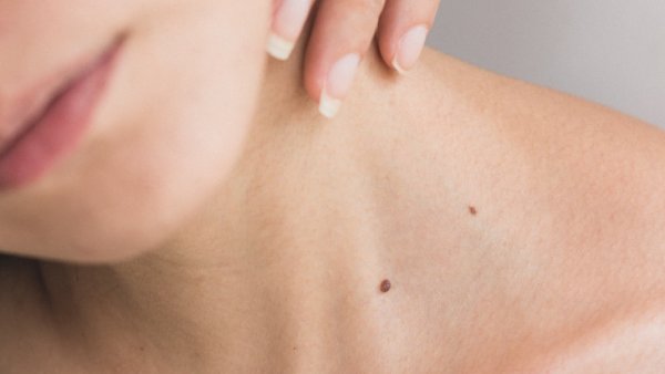 Prevención del cáncer a la piel: ¿a factores qué estar atento?
