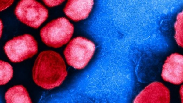 Minsal confirma primer fallecido en Chile por viruela del mono
