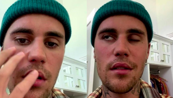 Lo sufre Justin Bieber: qué es, síntomas y cómo actúa el síndrome de Ramsay Hunt
