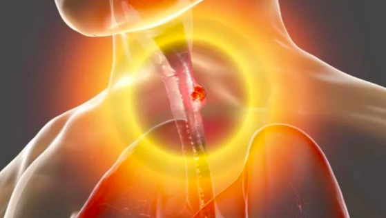 Cuáles son los síntomas del cáncer de esófago y por qué no debemos ignorarlos
