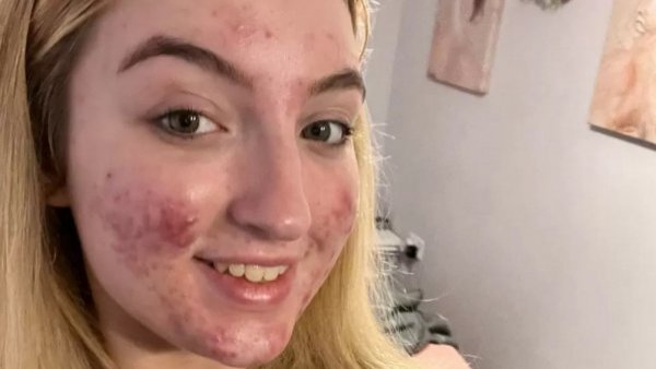 "Contenido espantoso": influencer acusa que TikTok cerró su cuenta por tener acné
