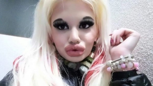 Mujer con los "labios más grandes del mundo" busca agrandar sus pómulos
