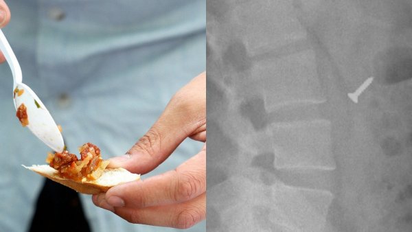 Mujer denunció haber ingerido un tornillo en colación servida por su empresa
