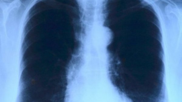 Tuberculosis: cómo se contagia, cuáles son sus síntomas y tratamiento

