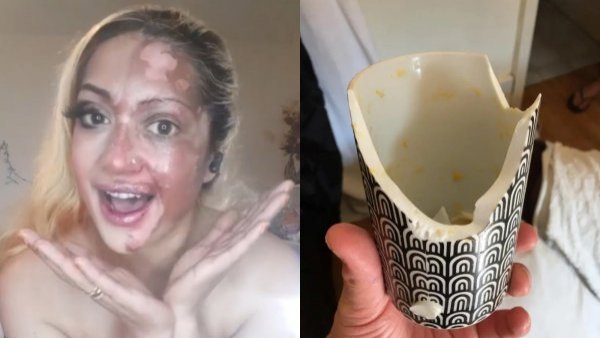 Por viral en TikTok: mujer terminó con graves quemaduras en la cara
