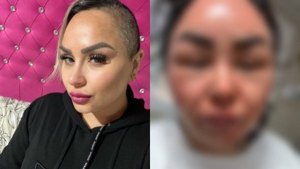 "Estoy con mucho dolor": Influencer Karen Frías sufre graves quemaduras tras explosión de olla a presión
