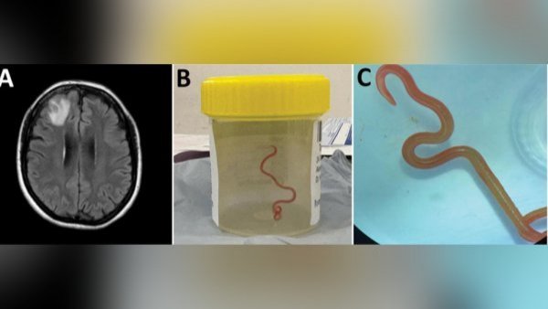 Medía 8 cm: extraen lombriz intestinal viva del cerebro de una mujer en Australia
