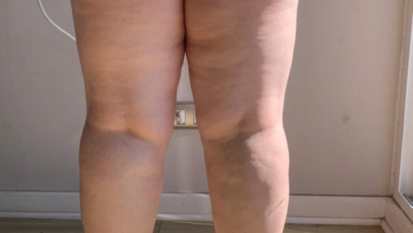 ¿Qué es el Lipedema? Responde estas 10 preguntas y sabrás si eres portadora de esta desconocida enfermedad
