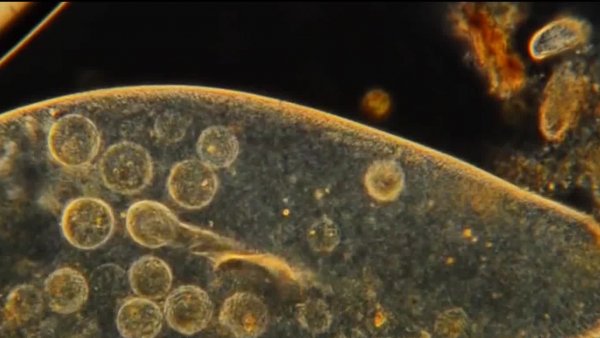 Reportaje: Alerta por bacteria en insumos hospitalarios
