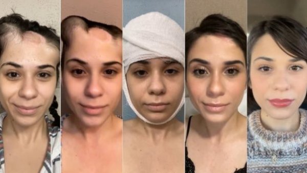 Joven se vuelve viral por increíble cambio tras vencer cáncer a la piel
