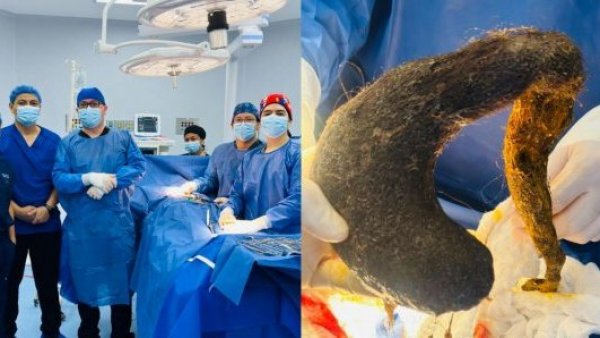 De terror: extraen bola gigante de cabello del estómago de una joven de 24 años en Ecuador
