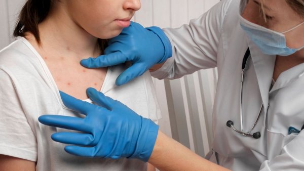 Viruela símica: cómo se contagia y por qué debemos estar en alerta