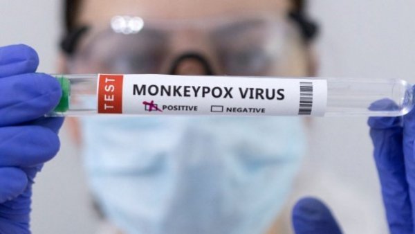 Seremi de Salud confirma caso de Mpox en Tarapacá
