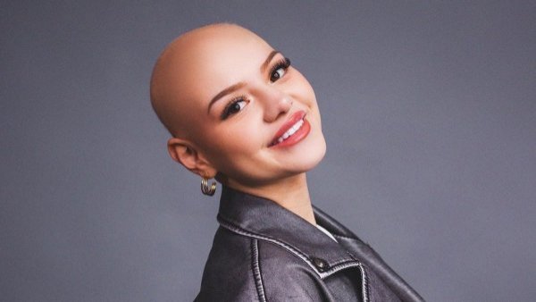 <p>Isidora Carvallo. Alopecia. </p>"Para mí se había acabado el mundo": aspirante a Miss Chile cuenta cómo sobrellevó su alopecia
