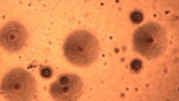 Región de O'Higgins: Muere niña de 13 años por neumonía a causa de bacteria Mycoplasma
