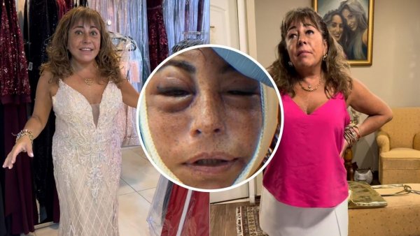 "Yo lo hice por mí, yo me operé porque quería verme más joven": Helhue Sukni se realizó delicada operación estética
