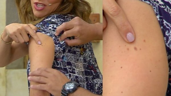 Para concientizar sobre el cáncer a la piel: María Luisa nos presenta los lunares que deberá extraerse

