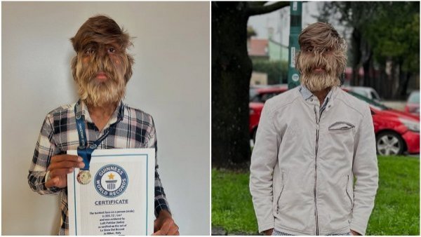 Joven logra el récord de la cara más peluda del mundo
