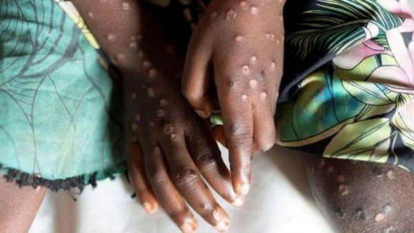 Brasil confirma el primer caso de variante de Mpox que generó mortal brote en África
