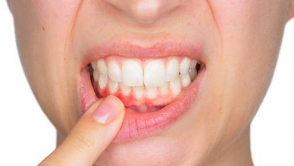 <p>Periodontitis: el riesgo de subestimar el sangrado de encías</p>Periodontitis: el riesgo de subestimar el sangrado de encías
