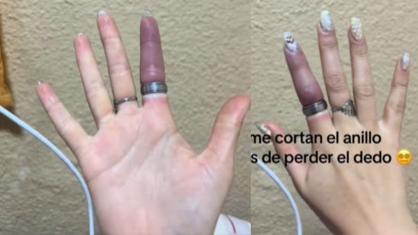 El increíble rescate de un dedo atrapado por un anillo en Argentina
