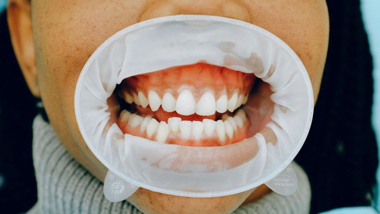 Sensibilidad dental: el dolor silencioso que afecta al 50% de los chilenos