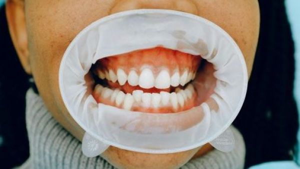 <p>Sensibilidad dental: el dolor silencioso que afecta al 50% de los chilenos</p>Sensibilidad dental: el dolor silencioso que afecta al 50% de los chilenos
