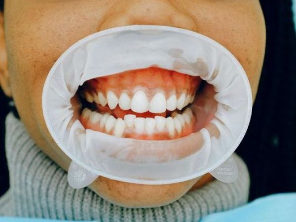 Sensibilidad dental: el dolor silencioso que afecta al 50% de los chilenos