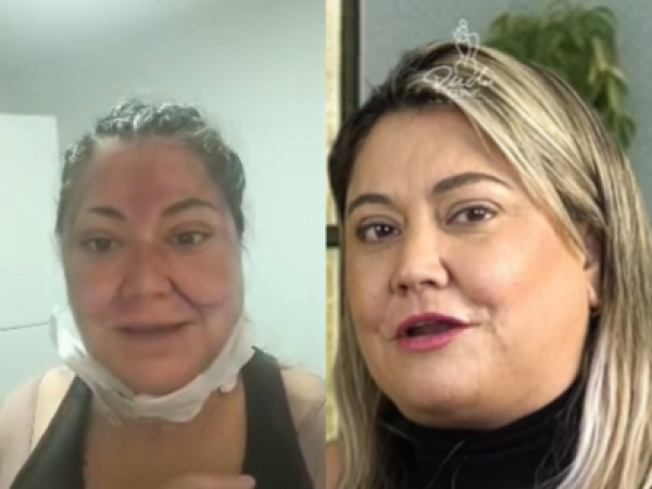 Denisse Campos se somete a importante cirugía estética: busca regresar a la TV