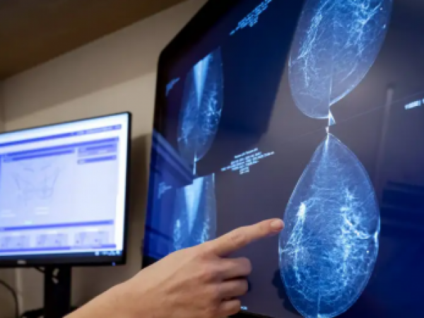Cáncer de mama: la IA revela lo invisible para los médicos