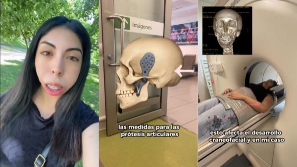 tres imágenes de una joven con malformación en su mandíbula
