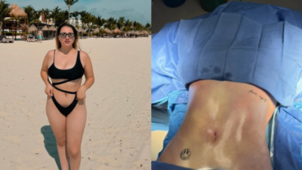 <p>Carlita Inostroza muestra su antes y después tras someterse a cirugía estética</p>