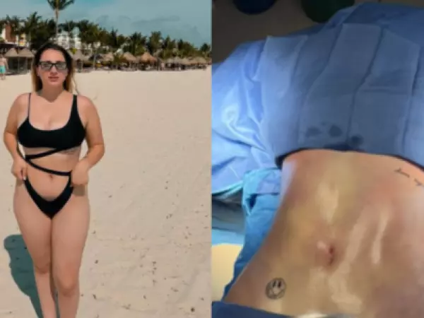 Carlita Inostroza muestra su antes y después tras someterse a cirugía estética