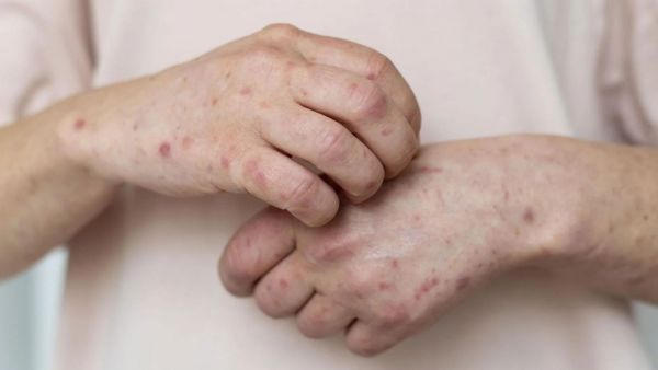 Ministerio de Salud confirma caso importado de Sarampión en la región Metropolitana
