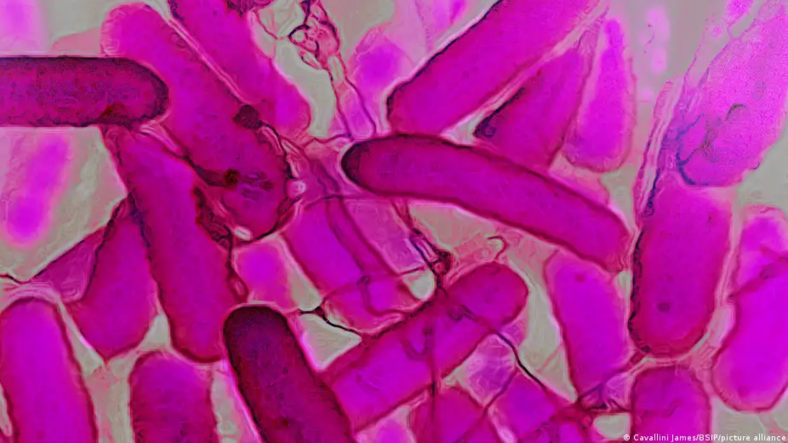 El raro síndrome intestinal que emborracha sin beber alcohol