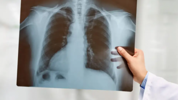 Ahora vive con normalidad: Paciente sobrevivió durante 48 horas sin pulmones
