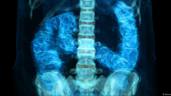 <p>Cáncer colorrectal avanza en jóvenes: los factores de riesgo</p>Cáncer colorrectal avanza en jóvenes: los factores de riesgo

