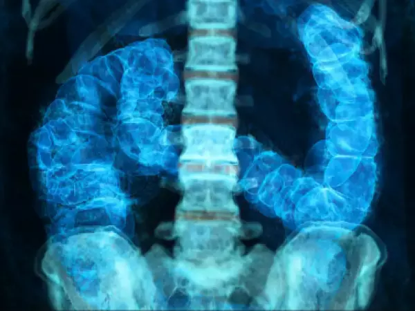 Cáncer colorrectal avanza en jóvenes: los factores de riesgo