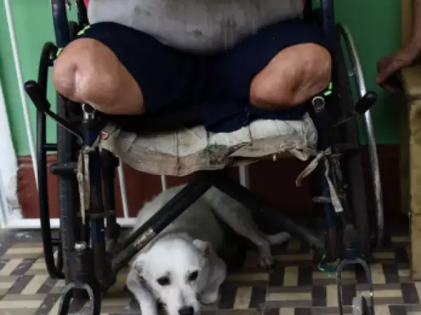 Chile es el primer país de América libre de lepra