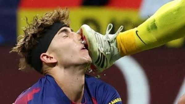 Impactantes imágenes: Así quedó el rostro de Fermín López tras patada de Juan Musso

