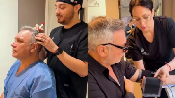 Así fue el procedimiento capilar al que se sometió Luis Jara