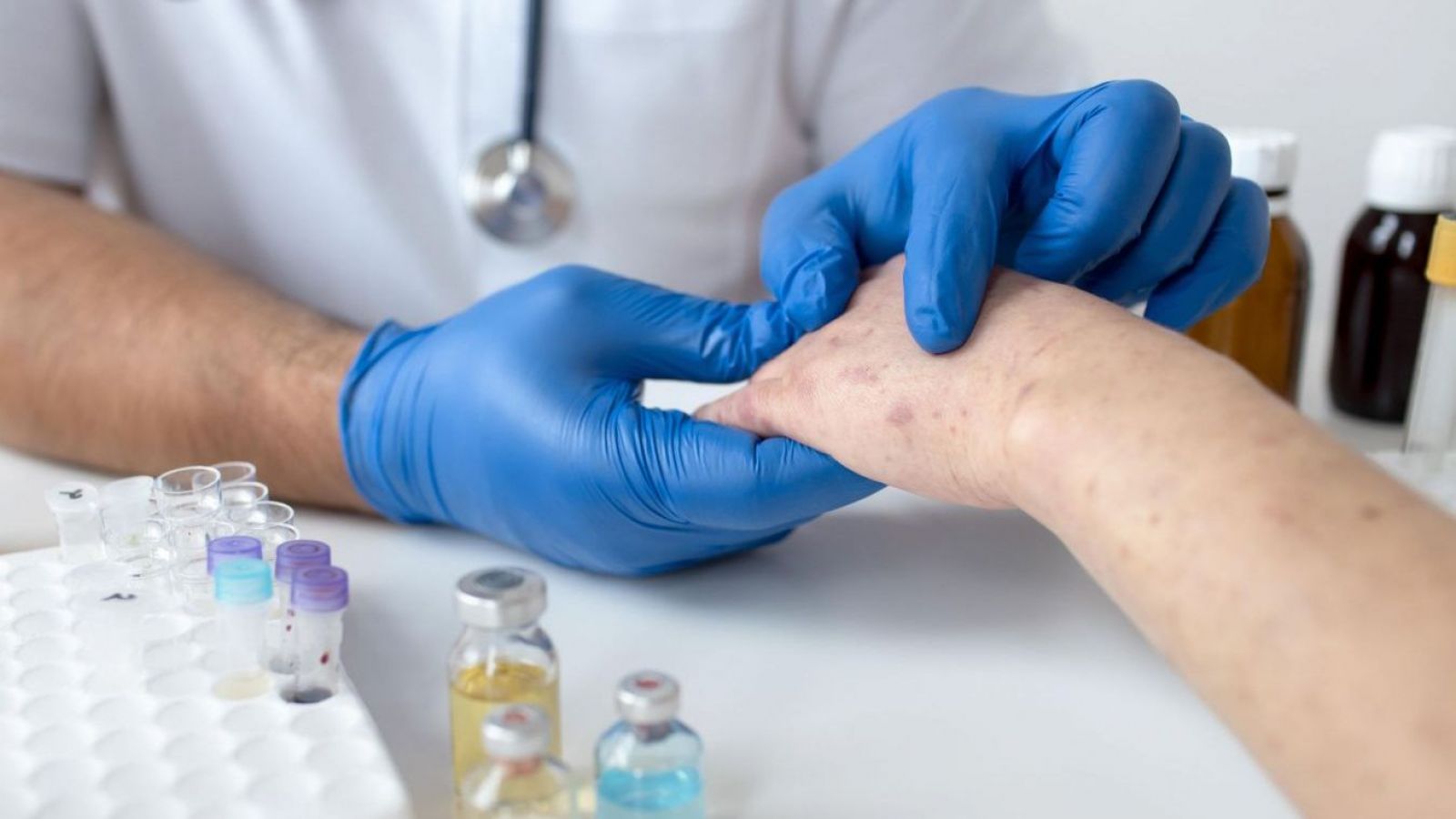 En su día mundial: ¿cómo detectar el lupus?
