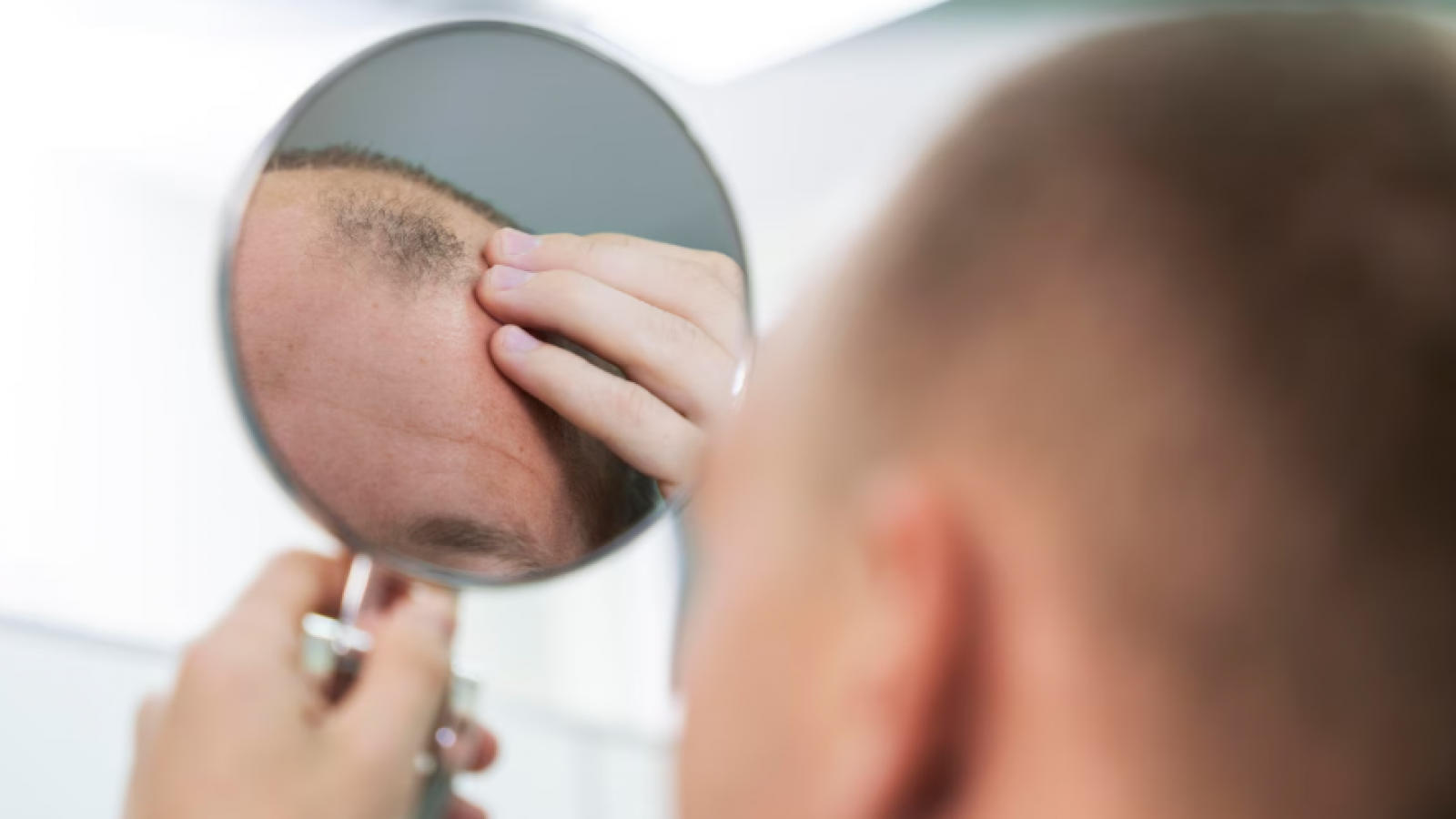 <p>Alopecia: los avances que prometen no solo frenar, sino revertir la caída del cabello</p>

