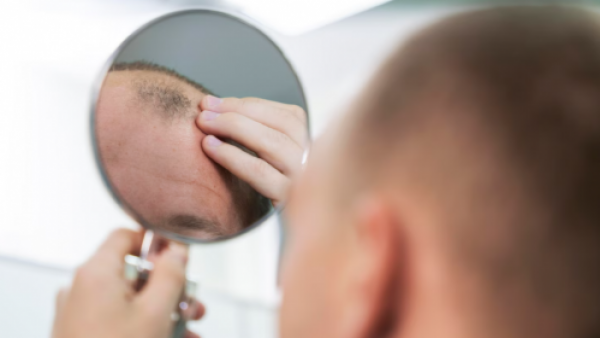 <p>Alopecia: los avances que prometen no solo frenar, sino revertir la caída del cabello</p>Alopecia: los avances que prometen no solo frenar, sino revertir la caída del cabello
