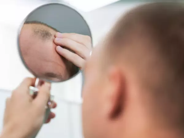 Alopecia: los avances que prometen no solo frenar, sino revertir la caída del cabello
